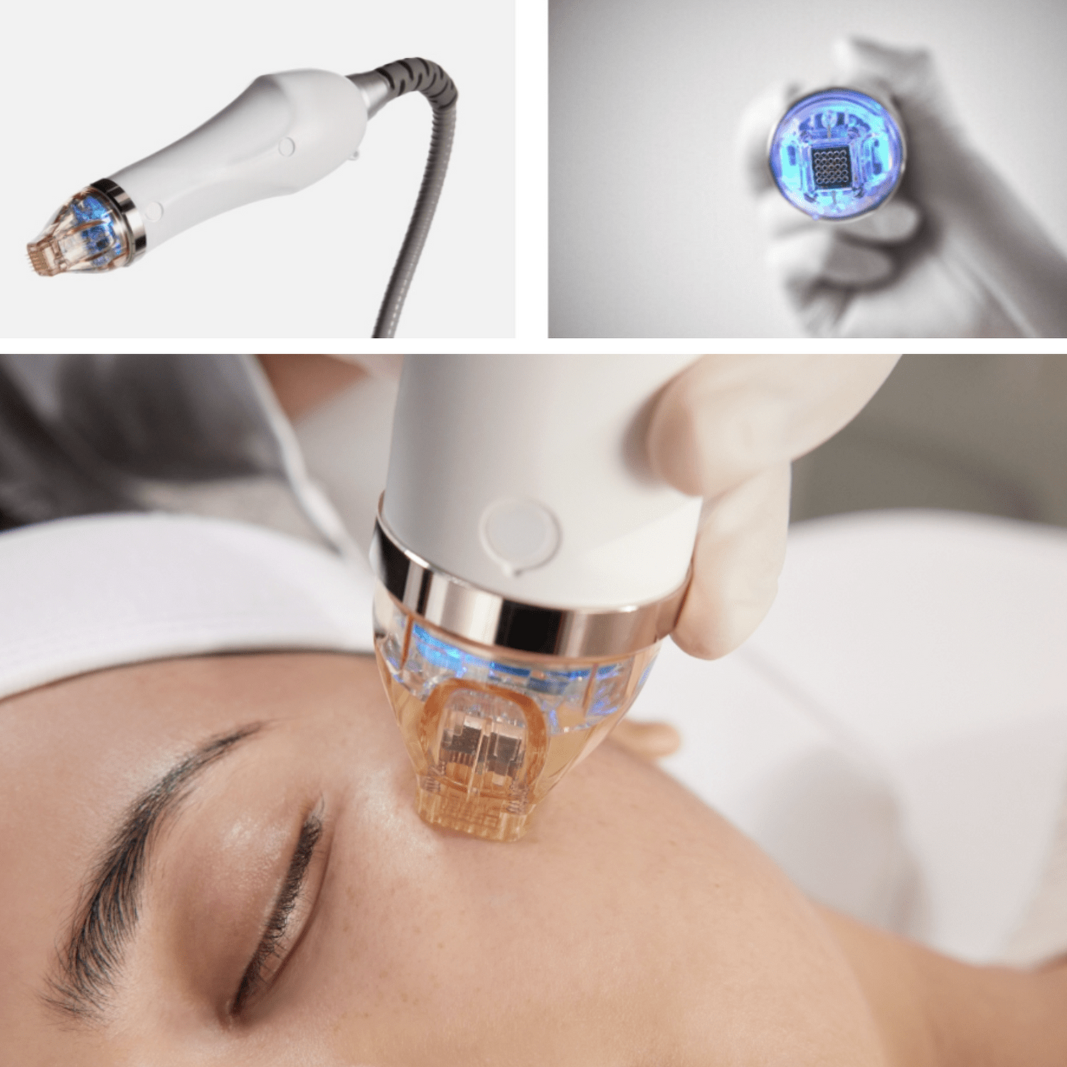 SECRET RF frakcinio odos atnaujinimo procedūra Beža Familia