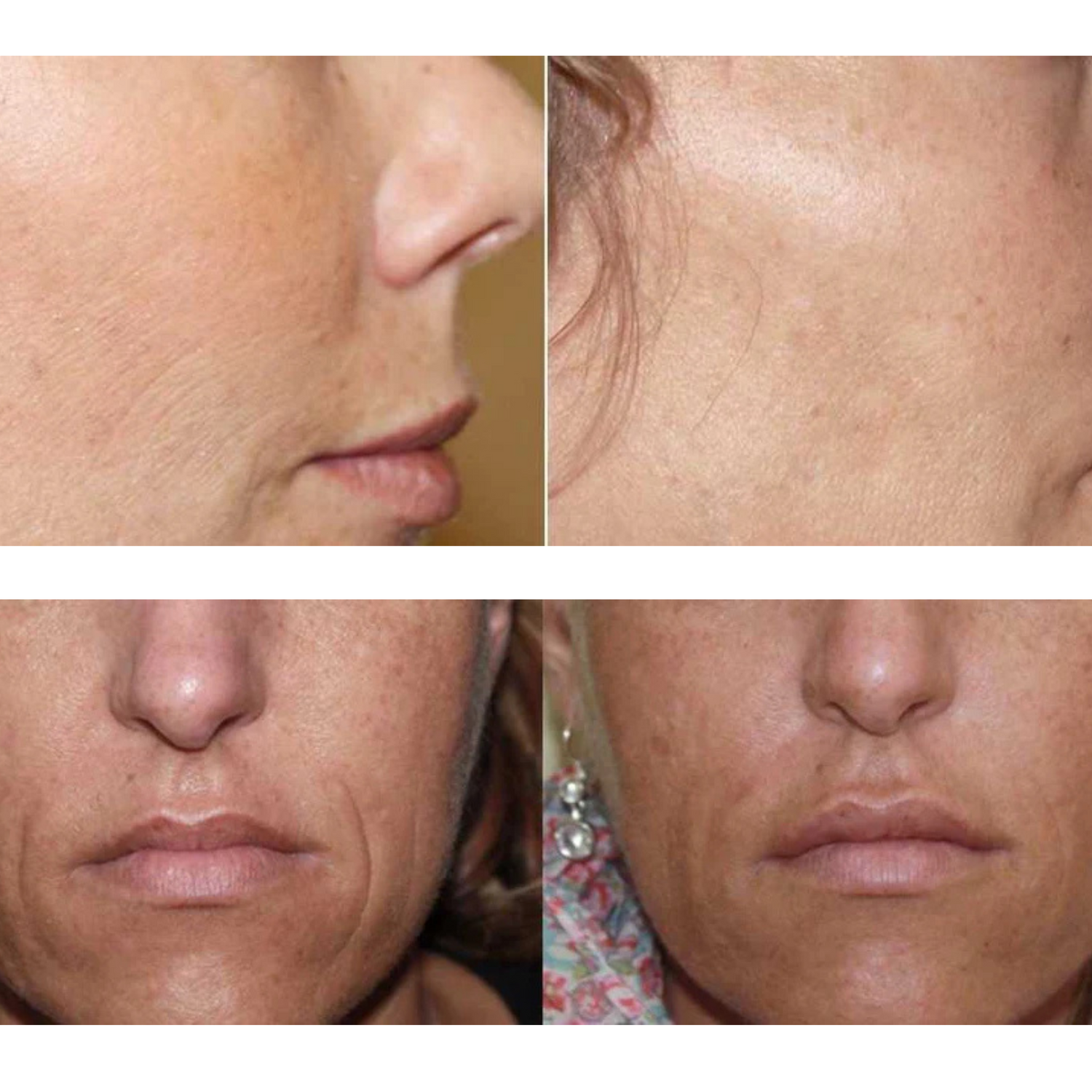 SECRET RF frakcinio odos atnaujinimo procedūra Beža Familia