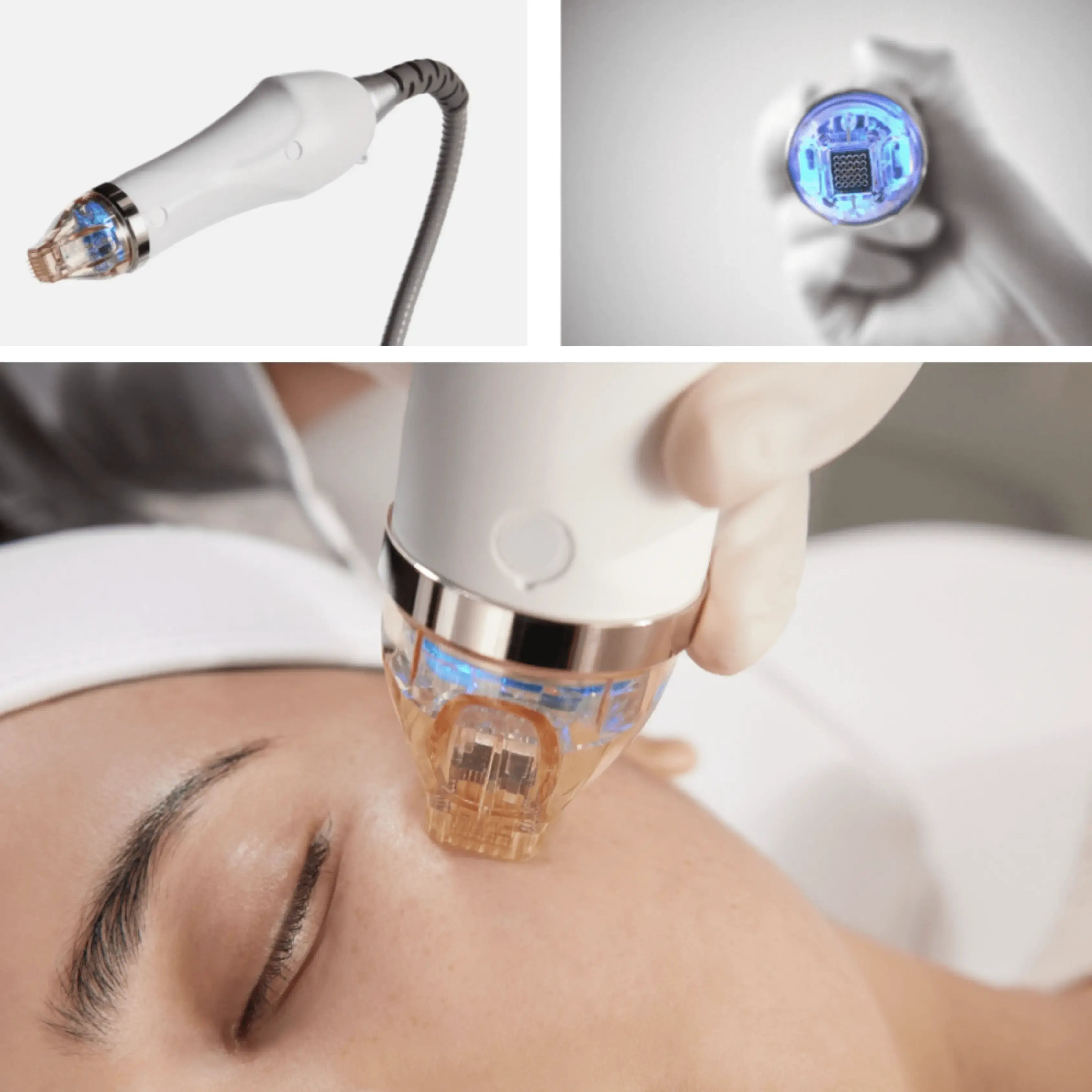 SECRET RF (mikroadatinis) frakcinis odos atjauninimas Beža Familia