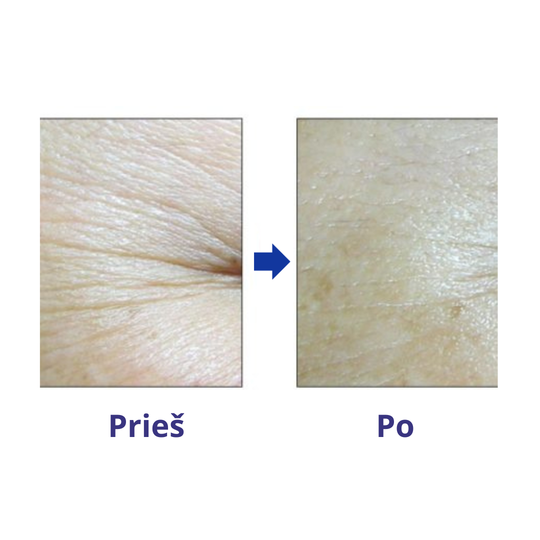 Veido atjauninimo NMN procedūra BEŽA