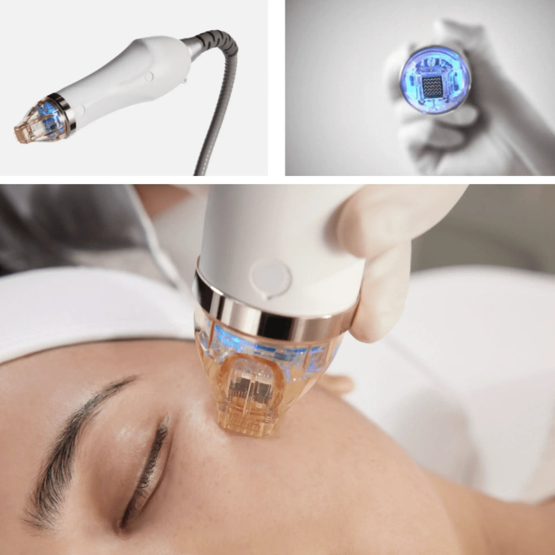 SECRET RF (mikroadatinis) frakcinis odos atjauninimas Beža Familia