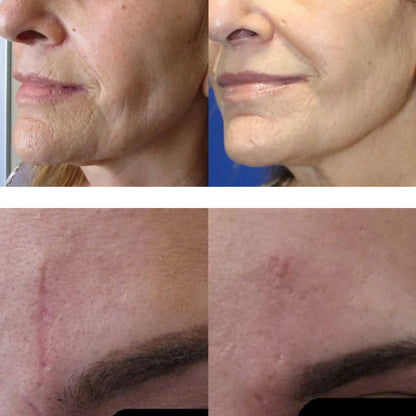 SECRET RF (mikroadatinis) frakcinis odos atjauninimas Beža Familia